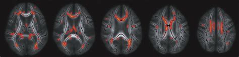 Structural Neuroimaging In Aging And Alzheimers Disease Radiology Key