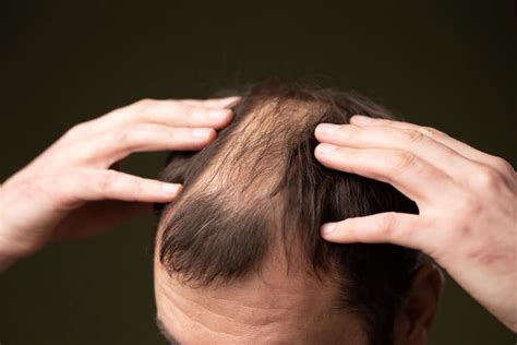What Causes A Bald Patch Affinity Health Affinity Health