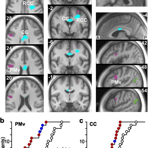 Increased Gray Matter Volume In Extrastriate Visual Areas Of Median