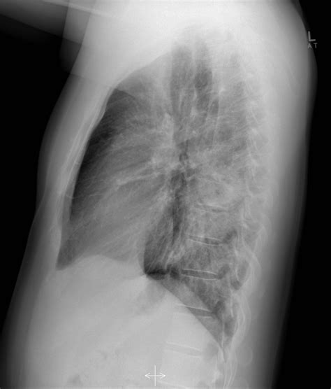 Left Lower Lobe Pneumonia Image
