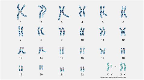 Down Syndrome Karyotype Chart