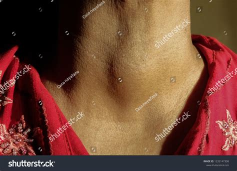 Anterior Neck Swelling Goitre库存照片1232147308 Shutterstock