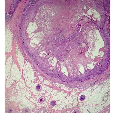 Microcystic Adnexal Carcinoma Deep Dermis Showing Infiltrating Tubules