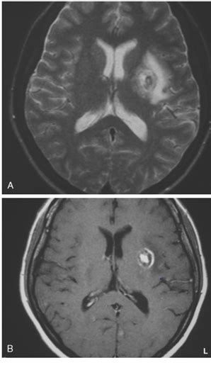Mri Brain Abnormal “aspergillosis” Radiology Imaging