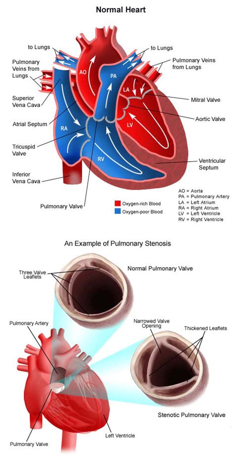 Pulmonary Stenosis Symptoms Diagnosis And Treatment Childrens Health