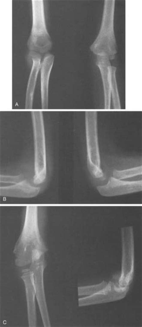 Physeal Fractures of the Elbow | Musculoskeletal Key