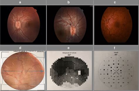 Optic Disc And Visual Field Images Of Patients With Papilledema Ad