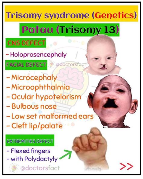 Patau Syndrome Trisomy 13 Defect What Is Patau Syndrome 👉 Patau