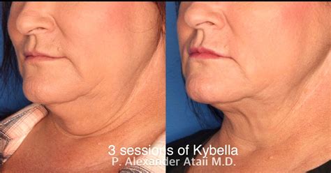 Kybella Before And After Photos Laser Cliniqúe