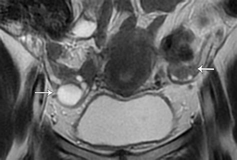 Mri Of Tumors And Tumor Mimics In The Female Pelvis Anatomic Pelvic