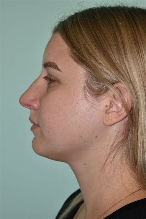 Rhinoplasty Davis Facial Plastic Surgery