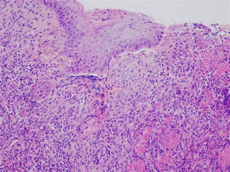 Eosinophilic granuloma is a form of langerhans cell histiocytosis. Clinical case - Dermatopatologia ...