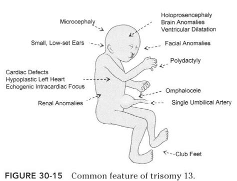 Characteristics Of Trisomy 13 Ultrasound Trisomy 13 Diagnostic