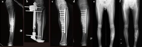 Chipping Corrective Osteotomy For Reconstruction Of Malunion With