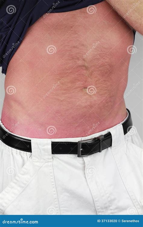 Sunburned Male Arm With Peel On Marine Background Sun Burned Female