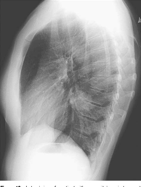 Figure From Lateral Chest Radiograph A Systematic Approach