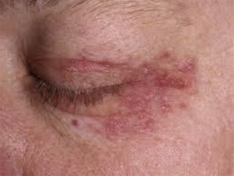 There are occasions when you all of a sudden notice that you have red specks. White Bump on the Eyelid - Causes and Treatment - (2020 ...