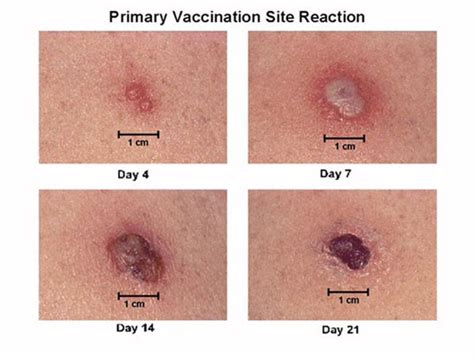 Smallpox Symptoms Vaccine Diangosis Treatment