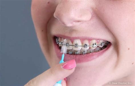 Brushing Flossing With Braces Smile Stars Pediatric Dentistry Baton Rouge Louisiana