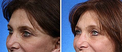 Fat Transfer Around The Eyes Steiger Facial Plastic Surgery Boca