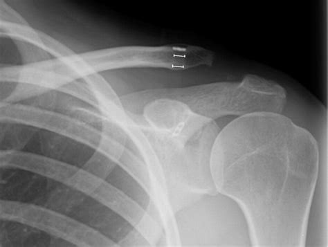 Suture Rupture In Acromioclavicular Joint Dislocations Treated With