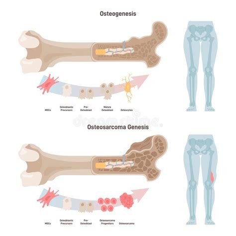 Osteogenesis And Osteosarcoma Cancerous Tumor Of A Human Bone Stock