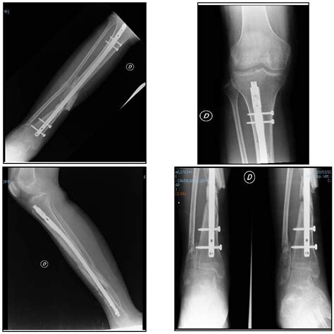 Jfmk Free Full Text Open Tibial Fracture In A Non Compliant Patient