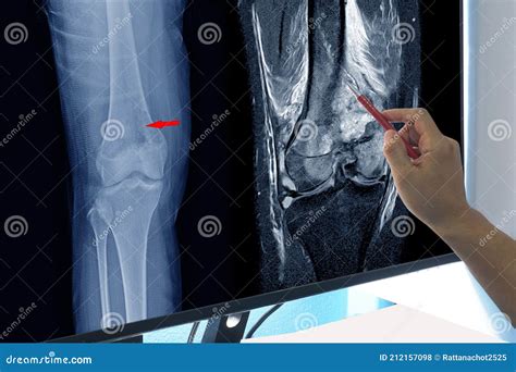 Magnetic Resonance Imaging Mri Of Right Knee Suggestive Of Malignant