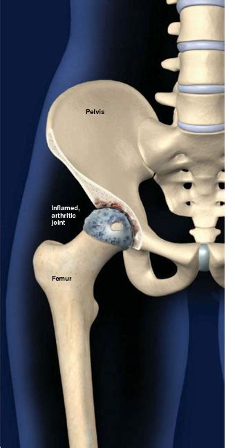 Inflammatory Arthritis Of The Hip Orthopedic Doctor Prescott Az
