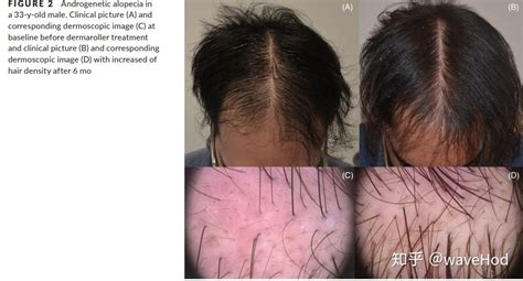 2019年新研究：在不同类型的脱发中使用微针的初步效果 知乎