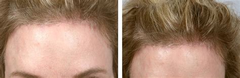 The Hairline Brow Lift Clinics In Plastic Surgery