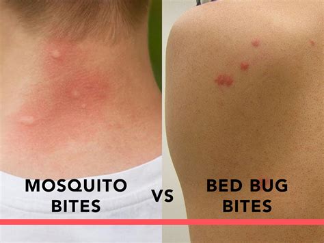 Does Bed Bug Bites Have Whiteheads Caregeh