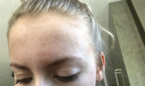 Forehead Suddenly Covered In Tiny Bumps Does This Look Like Fungal