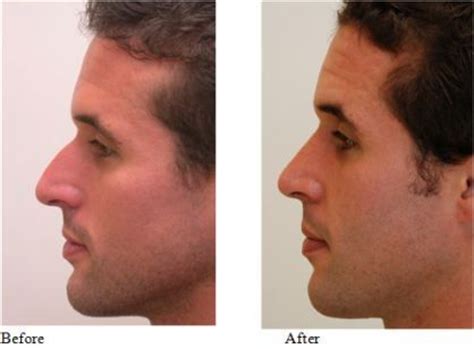 If you are reading this you are almost certainly aware of the advances that cosmetic procedures have made in. Male Rhinoplasty | Rhinoplasty, Rhinoplasty before and ...