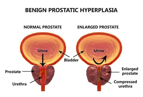 prostate enlargement urologist urohealth medical clinic