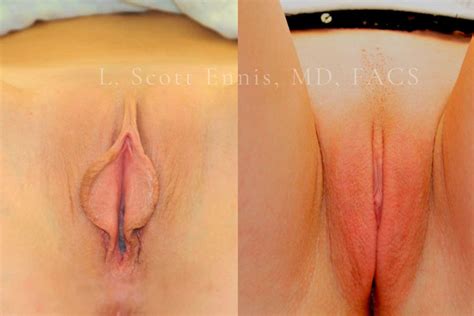 Female Genital Rejuvenation In Palm Beach At Ennis Plastic Surgery Boca