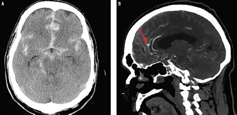 Case Report Cerebral Aneurysm Rerupture Practical Neurology