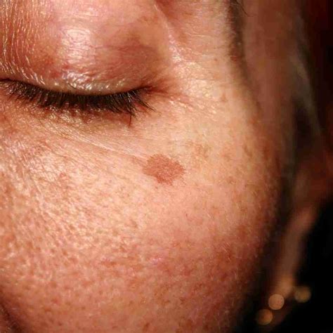 Dark Spots On Face Organic Apoteke