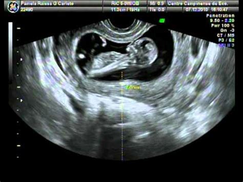 A dançarina compartilhou um vídeo do momento especial em seu canal do youtube. Ultrassom de gêmeos em 3D/ 4D (12-13 semanas) - YouTube