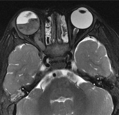 High Resolution Mr Imaging Of The Orbit In Patients With Retinoblastoma