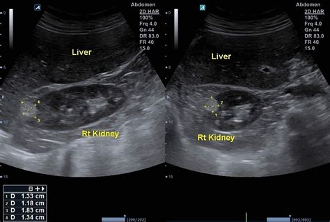 Angiomyolipoma Or Renal Angiomyolipoma Causes Symptoms And Treatment