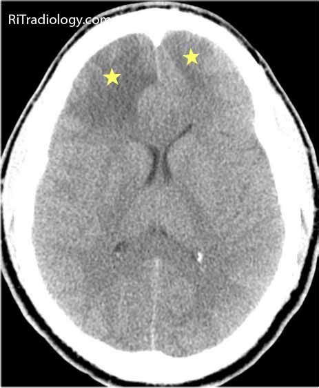 What causes cerebral venous sinus thrombosis? RiT radiology: June 2011