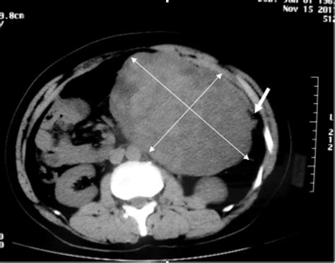 Abdominal Computed Tomography Ct Scan Showed A Huge Mass Measuring