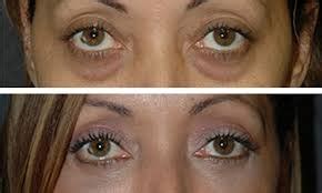 A woman named ng from kuala lumpur underwent a dst (double suture and twist) surgery as well as an eyelid fat removal surgery, and wound up with a hugely. Important Reasons To Choose Asian Double Eyelid Surgery ...
