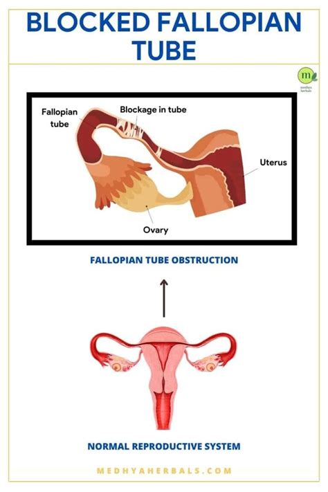 The Best Ayurveda Treatment For Blocked Fallopian Tubes Fertility