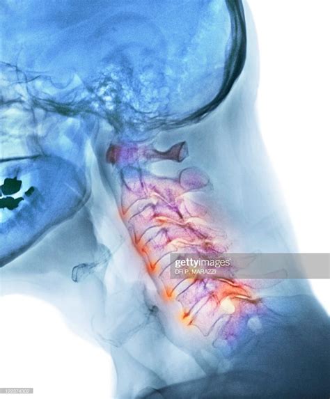 Arthritis Of The Neck Coloured X Ray Of The Arthritic Cervical Spine