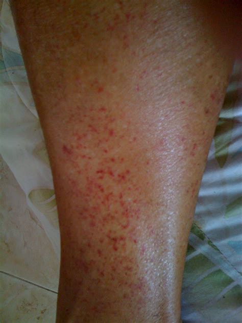 What Causes Red Rash On Lower Legs Printable Templates Protal