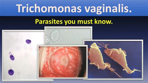 Trichomonas Vaginalis Life Cycle Lab Diagnosis Infection Transmission Trichomonasvaginalis