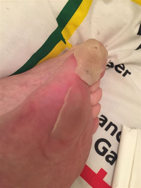 Peeling sheet skin on feet #2 : Psoriasis