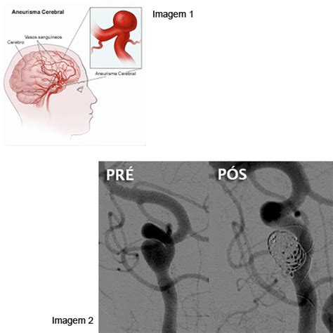 O que é um aneurisma dissecante? HCI - Hemodinâmica e Cardiologia Invasiva - Ver Artigo